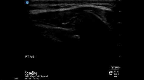 Rib Ultrasound Subluxation At The Costochondral Junction Long Axis