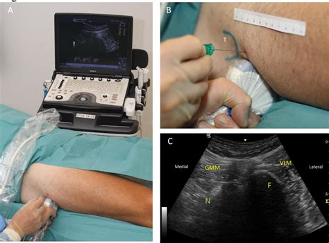 Proximal Lateral Approach To Ultrasound Guided Sciatic Nerve Block A