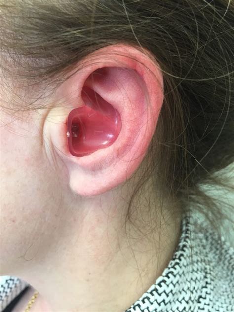 Ear Plugs Dr Bridget Clancy Ent Surgeon