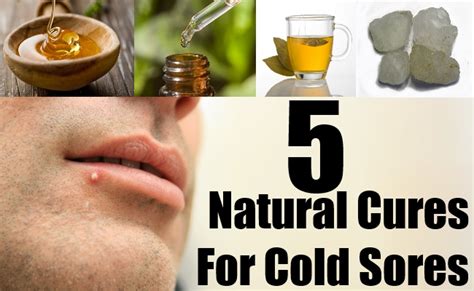 5 Natural Cures For Cold Sores Natural Home Remedies And Supplements