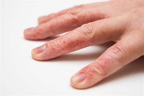 Dry Cracked Skin Condition Eczema Stock Photos Pictures And Royalty Free