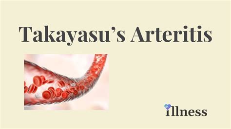 Takayasus Arteritis Overview Causes Symptoms Treatment