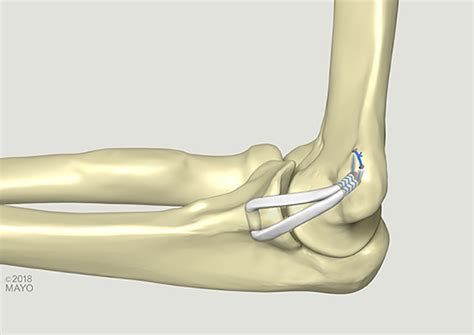 Reconstruction Of The Medial Ulnar Collateral Ligament Of The Elbow