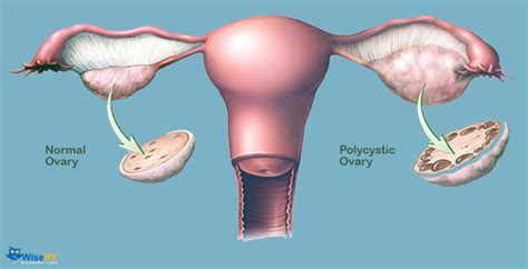 It is characterized by irregular menstrual periods, excess male hormones, and/or ovarian cysts. Interesting Facts About PCOS