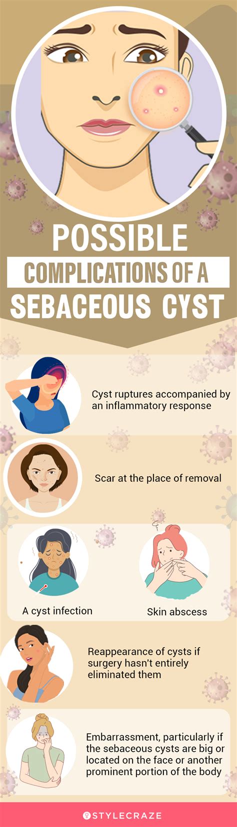 14 Home Remedies To Treat Sebaceous Cysts