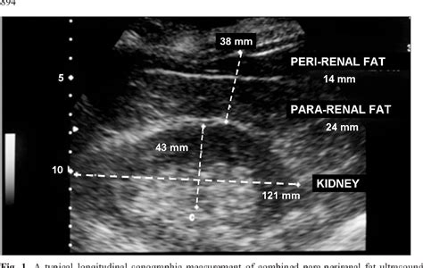Figure 1 From Para And Perirenal Fat Thickness Is An Independent