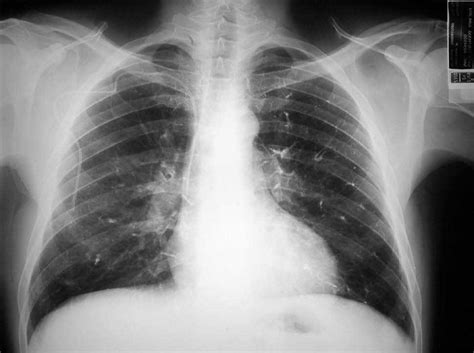 Signs of a pe include l. Trombosis Pulmonar - Embolia Pulmonar Aguda Articulos ...