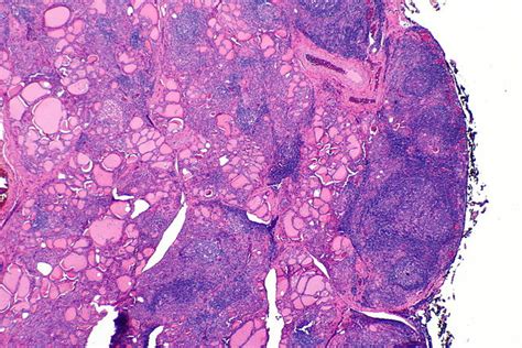 Sign out history provided total thyroid, total thyroidectomy: Difference Between Hashimoto and Hypothyroidism ...