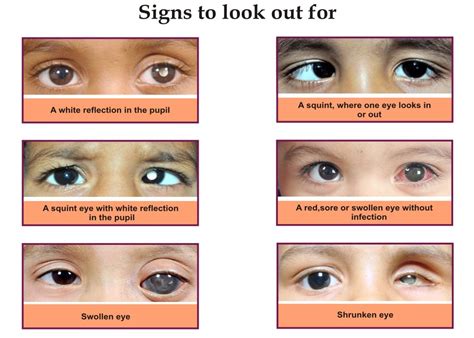 Symptoms of eye cancer in babies. Retinoblastoma - Symptoms, Diagnosis, Treatments Of ...