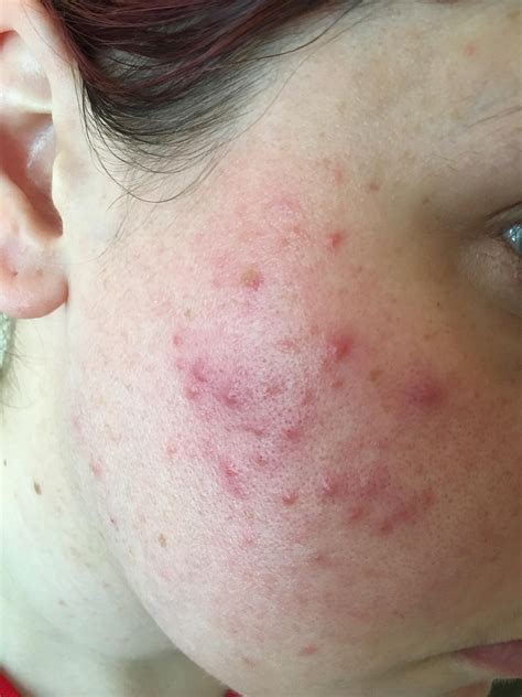 Skin Concerns Moved Country And Suddenly Right Cheek Acne