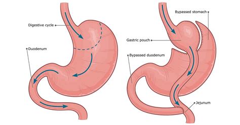 Gastric Bypass Roux En Y Colquitt Regional Medical Center