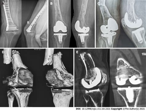 Treatment Of Periprosthetic Knee Infection And Coexistent
