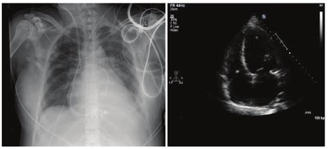 Postpartum Cardiomyopathy X Ray Chest And Echocardiography Showing