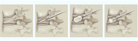 Kyphoplasty Spine Surgery Las Vegas Nv Vertebroplasty Treatment