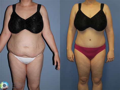Belly Fat Liposuction