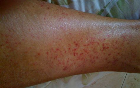Photos Of Stasis Dermatitis Symptoms And Pictures
