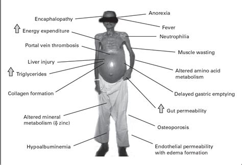 Figure 1 From Treatment Of Alcoholic Liver Disease Semantic Scholar