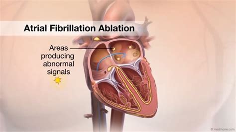 Cardiovascular Videos Cvml A Atrial Fibrillation Ablation On Vimeo