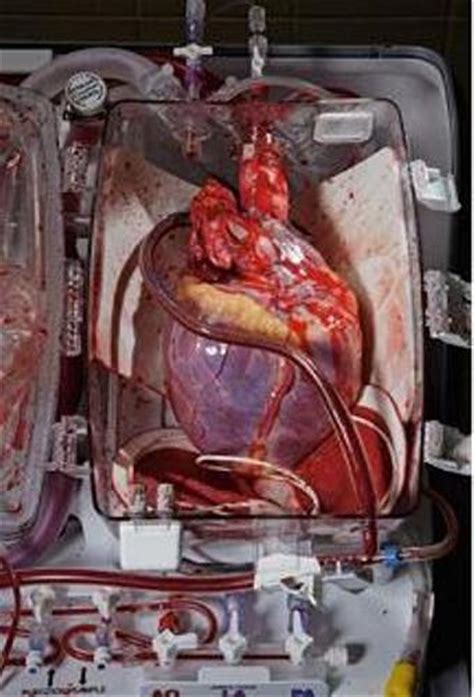 10 Interesting Heart Transplant Facts My Interesting Facts