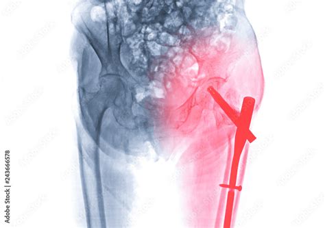 X Ray Left Hip Replacement Hip Painful Skeleton X Ray Isolated On