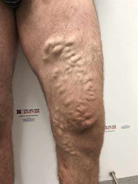 Varicose Vein Results And Post Treatment Photos — The Leg Vein Doctor Brisbane Varicose And
