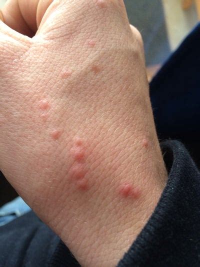I Have A Strange Rash Of Raised Red Bumps On My Hands Help Please