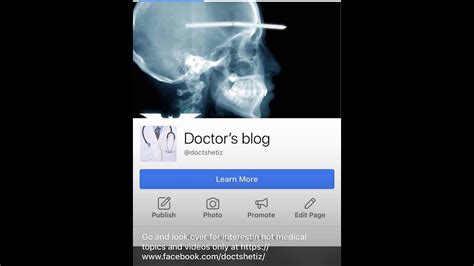 Penile Fracture Surgerydoctorsblogdoctshetiz Youtube