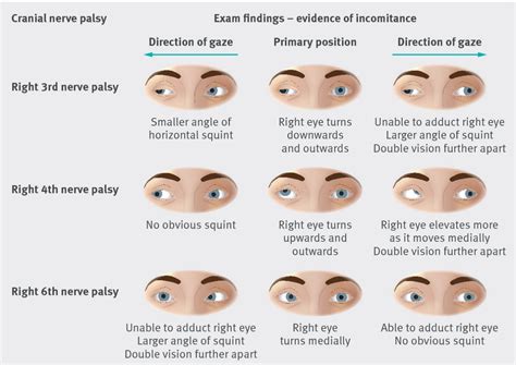 Physical Exam Findings Of Various Ocular Palsies Image Grepmed