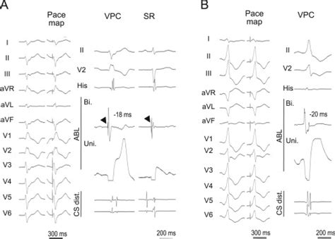 Electrophysiological Study And Catheter Ablation For Catecholaminergic