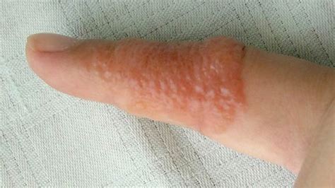 Dyshidrotic Eczema Overview Causes Diagnosis And Pictures