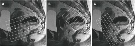 Figure 1 From Magnetic Resonance Imaging For Diagnosis And Neoadjuvant Treatment Evaluation In