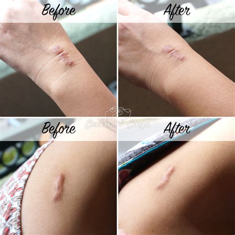 So, use these medical grade silicone sheets for scars. Using ScarAway for Treating Keloids and Other Scars
