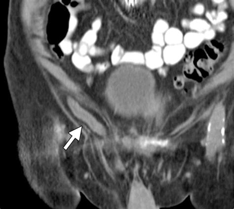 Appendicitis Atypical And Challenging Ct Appearances Resident And