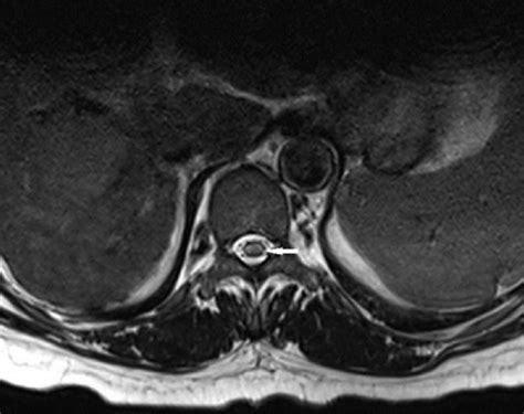 T2 Weighted Axial Mri Of The Thoracic Spine At The T10 Open I