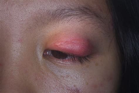 Cellulitis Of The Eye Orbital Cellulitis Nvision Eye Centers