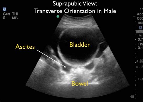If there is fluid over there, that is noticed in ultrasonography. Suprapubic ultrasound view with free fluid. | Download ...