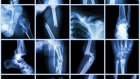 Understanding The Different Types Of Bone Fractures C