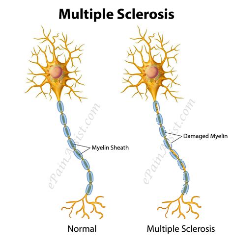 Multiple Sclerosis Or Disseminated Sclerosis Types Risk Factors Symptoms Treatment