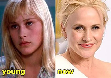 Patricia Arquette Plastic Surgery Before And After Photos