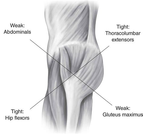 Regular, moderate exercise such as walking, swimming, yoga or bicycling can help stretch and strengthen muscles, improve posture and enhance mobility. Cross syndrome causes, symptoms, diagnosis, treatment ...