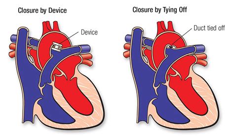 A personal digital assistant (pda), also known as a handheld pc, is a variety mobile device which functions as a personal information manager. Patent Ductus Arteriosus (PDA) | American Heart Association