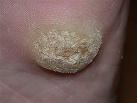 How Common Are Warts In Adults