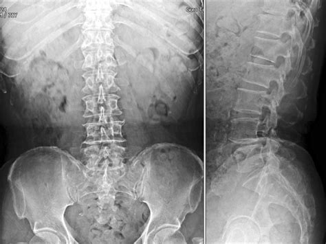 Radiographic Anatomy Of The Skeleton Lumbar Spine Lateral View Images