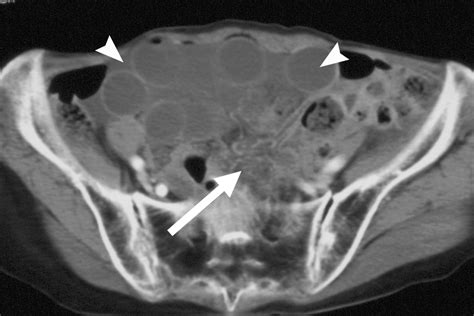 Ct Of Internal Hernias Radiographics