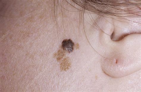Seborrheic Keratosis On Human Skin Stock Image C0086219 Science