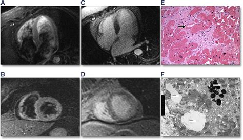 Novel Use Of Cardiac Magnetic Resonance Imaging For The Diagnosis Of