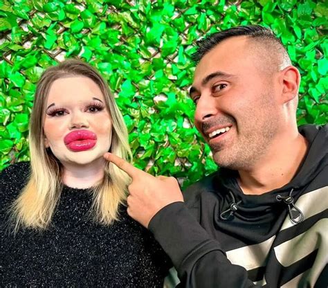 Meet A Woman Who Has The Biggest Lips In The World And Wants To Make Them Even Bigger Bright