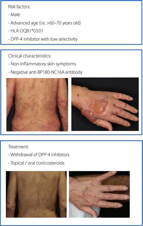 What Is The Treatment For Bullous Pemphigoid Sciencehub