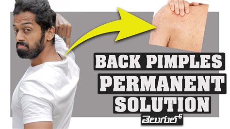 How To Remove Back Pimples Naturally 7 Remedies Youtube