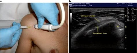 Ultrasound Guided Shoulder Joint And Bursa Injections NYSORA